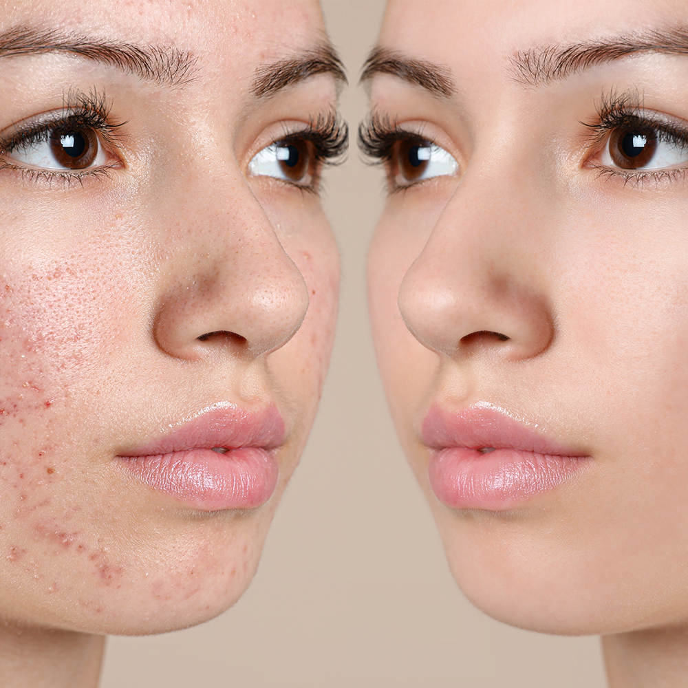 Exfoliating Acne Cleanser